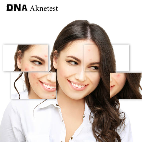 DNA Akne test